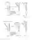 Fig. 34 - Suture sleeve patch and methods of delivery within an existing arthroscopic workflow