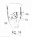 Fig. 41 - Suture sleeve patch and methods of delivery within an existing arthroscopic workflow