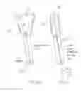 Fig. 44 - Suture sleeve patch and methods of delivery within an existing arthroscopic workflow