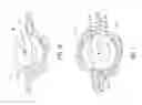 Fig. 08 - Surgical bur with a single cutting flute