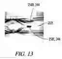 Fig. 10 - Clot retrieval system