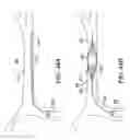 Fig. 47 - Clot retrieval system