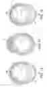 Fig. 07 - Rotational Atherectomy Device