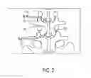 Fig. 03 - Percutaneous methods for spinal stenosis and foraminal stenosis