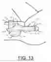 Fig. 14 - Prosthetic Artificial Insemination Device
