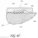 Fig. 12 - Method and apparatus for sacroiliac joint fixation