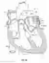 Fig. 23 - Ablation method for creating elongate continuous lesions enclosing multiple vessel entries