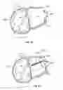 Fig. 25 - Ablation method for creating elongate continuous lesions enclosing multiple vessel entries