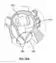 Fig. 30 - Ablation method for creating elongate continuous lesions enclosing multiple vessel entries