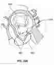 Fig. 31 - Ablation method for creating elongate continuous lesions enclosing multiple vessel entries