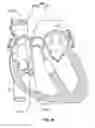 Fig. 33 - Ablation method for creating elongate continuous lesions enclosing multiple vessel entries