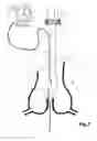 Fig. 08 - Device For Cutting Off And Removing Calcified Tissue From A Heart Valve