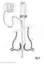 Fig. 09 - Device For Cutting Off And Removing Calcified Tissue From A Heart Valve
