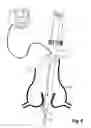 Fig. 10 - Device For Cutting Off And Removing Calcified Tissue From A Heart Valve