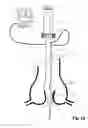 Fig. 11 - Device For Cutting Off And Removing Calcified Tissue From A Heart Valve