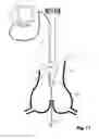 Fig. 12 - Device For Cutting Off And Removing Calcified Tissue From A Heart Valve