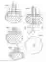 Fig. 02 - Surgical vaporization electrode