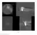 Fig. 03 - Dental Ring