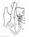 Fig. 02 - Adaptively positioned mitral valve closure plate blocker for repairing mitral regurgitation
