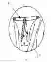 Fig. 06 - Adaptively positioned mitral valve closure plate blocker for repairing mitral regurgitation