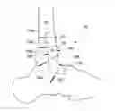 Fig. 01 - Transcortal bone joint fusion system