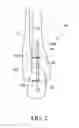 Fig. 03 - Transcortal bone joint fusion system