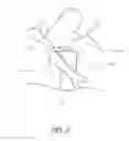 Fig. 03 - Method and apparatus for minimally invasive insertion of intervertebral implants