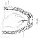 Fig. 44 - LANYARD SYSTEMS FOR PROSTHETIC DEVICES AND RELATED METHODS