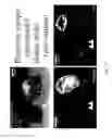 Fig. 05 - Compositions and methods for selective phagocytosis of human cancer cells