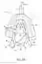 Fig. 03 - Methods and systems for improving airway patency