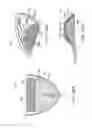 Fig. 33 - Methods and systems for improving airway patency