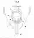 Fig. 03 - Fluid delivery system to airway