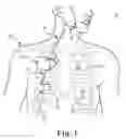 Fig. 02 - Percutaneous access for systems and methods of treating sleep-related disordered breathing