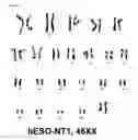 Fig. 12 - HUMAN PLURIPOTENT STEM CELLS PRODUCED BY SOMATIC CELL NUCLEAR TRANSFER