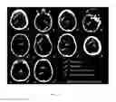 Fig. 16 - Method and system for identifying bleeding