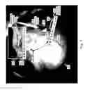 Fig. 08 - Location indicator for optical coherence tomography in ophthalmic visualization