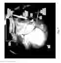 Fig. 09 - Location indicator for optical coherence tomography in ophthalmic visualization