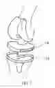Fig. 03 - IN VIVO MEASUREMENT OF CELL CONCENTRATIONS IN FLUID NEAR AN IMPLANTED MEDICAL DEVICE