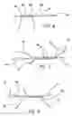 Fig. 03 - All-suture suture anchor systems and methods