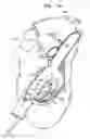 Fig. 02 - Tissue anchor and delivery tool