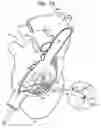 Fig. 03 - Tissue anchor and delivery tool