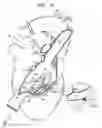 Fig. 04 - Tissue anchor and delivery tool