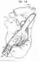 Fig. 05 - Tissue anchor and delivery tool