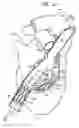 Fig. 06 - Tissue anchor and delivery tool