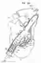 Fig. 08 - Tissue anchor and delivery tool