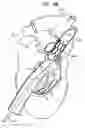 Fig. 12 - Tissue anchor and delivery tool