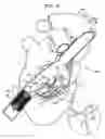 Fig. 20 - Tissue anchor and delivery tool