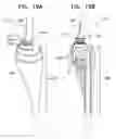 Fig. 32 - Tissue anchor and delivery tool