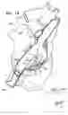 Fig. 33 - Tissue anchor and delivery tool