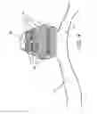 Fig. 04 - Occlusion device